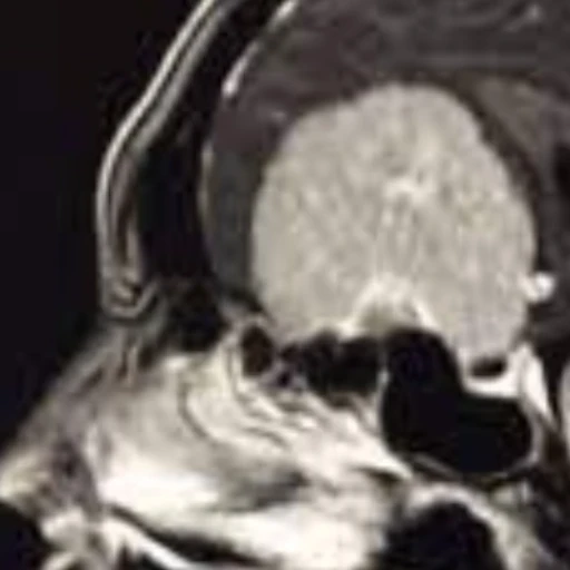 Logran descodificar fluido cerebral para combatir tumores